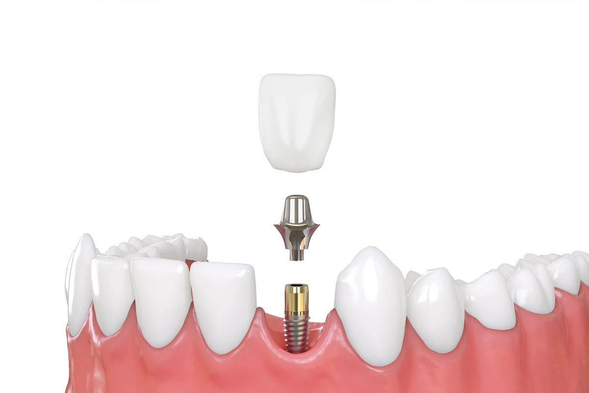 Restore Confidence And Bite With Dental Implants