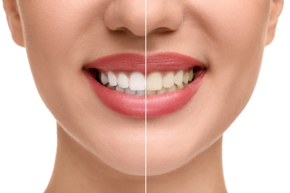 A female patient of City Family Dental Care is smiling to show her before and after teeth whitening treatment